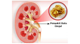 Illustration for article titled obat batu empedu batu ginjal